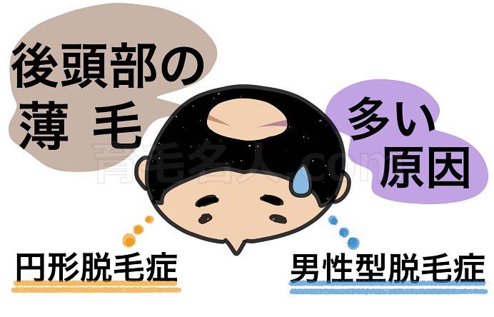 後頭部の薄毛の主な原因は円形脱毛症と男性型脱毛症