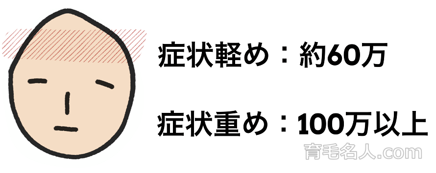 M字部分に植毛する場合の費用