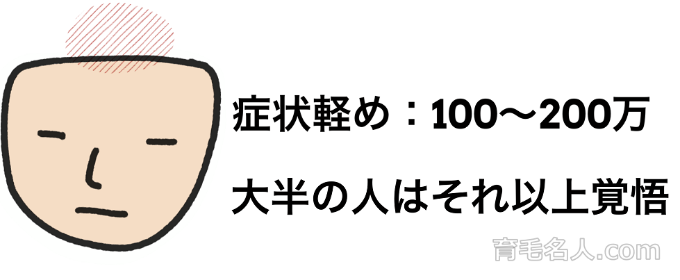 頭頂部に植毛する場合の費用