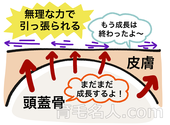 頭の形が変化するとハゲの原因になる仕組み
